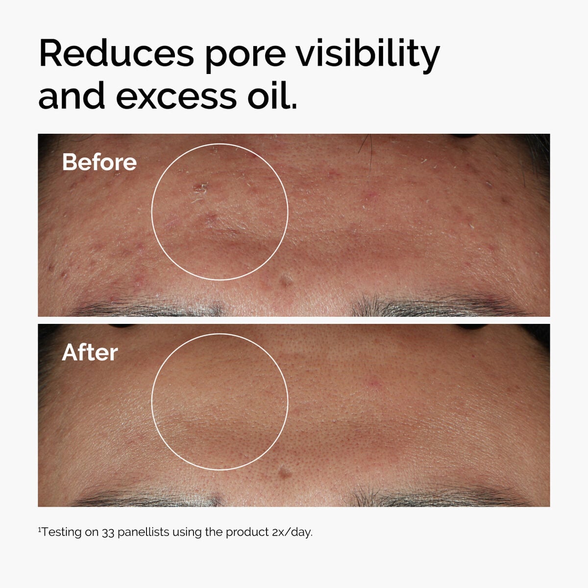 niacinamide-10-zinc-1-o4 ord-niacinamide-zinc-blemish-serum-before-after-pores.jpg