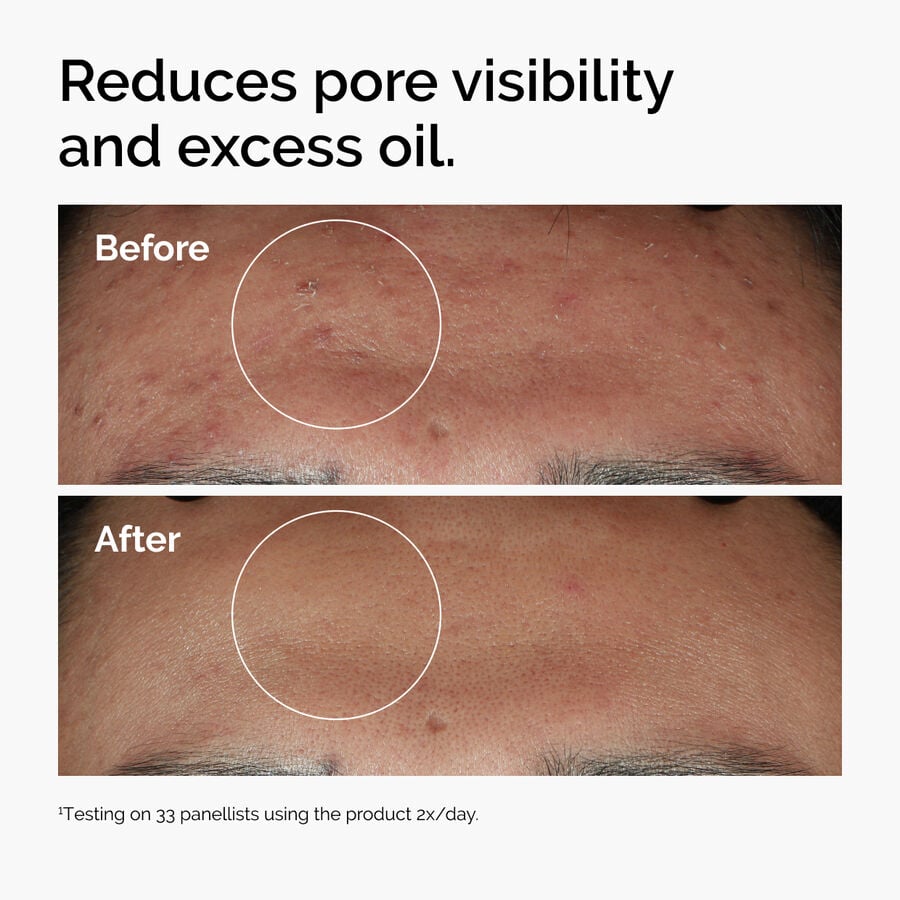 niacinamide-10-zinc-1-o4 ord-niacinamide-zinc-blemish-serum-before-after-pores.jpg