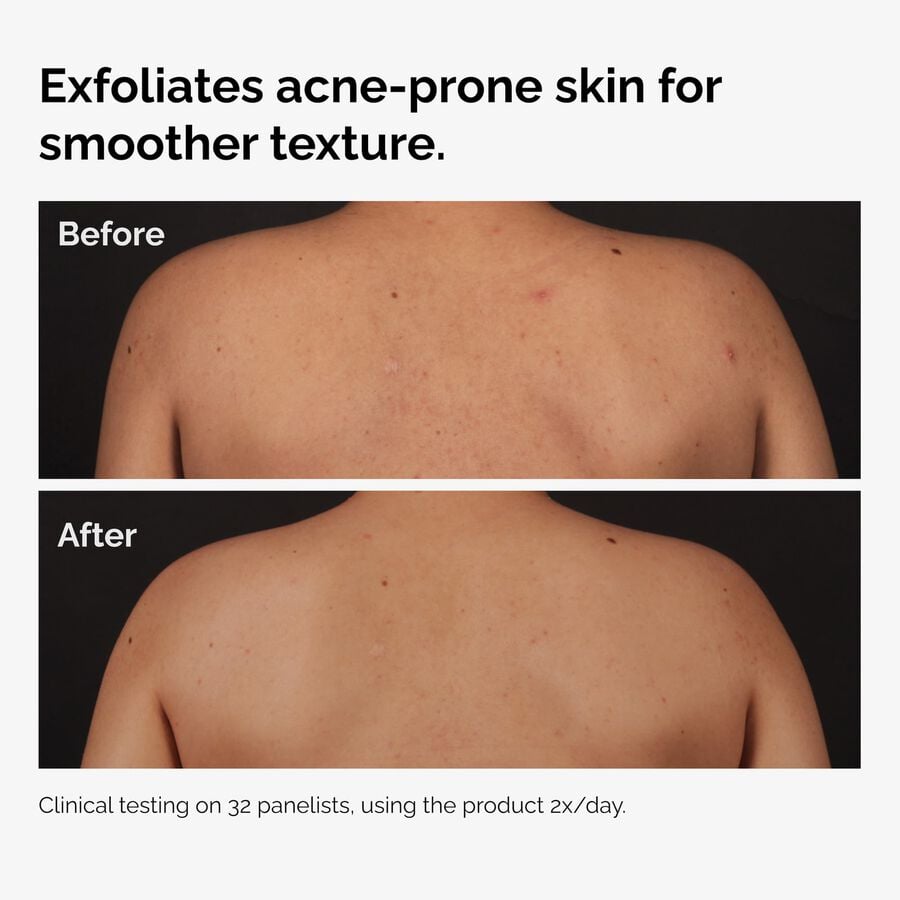 the-body-care-collection-y1 ord-salicylic-acid-body-serum-before-after-graphic-NA.jpg