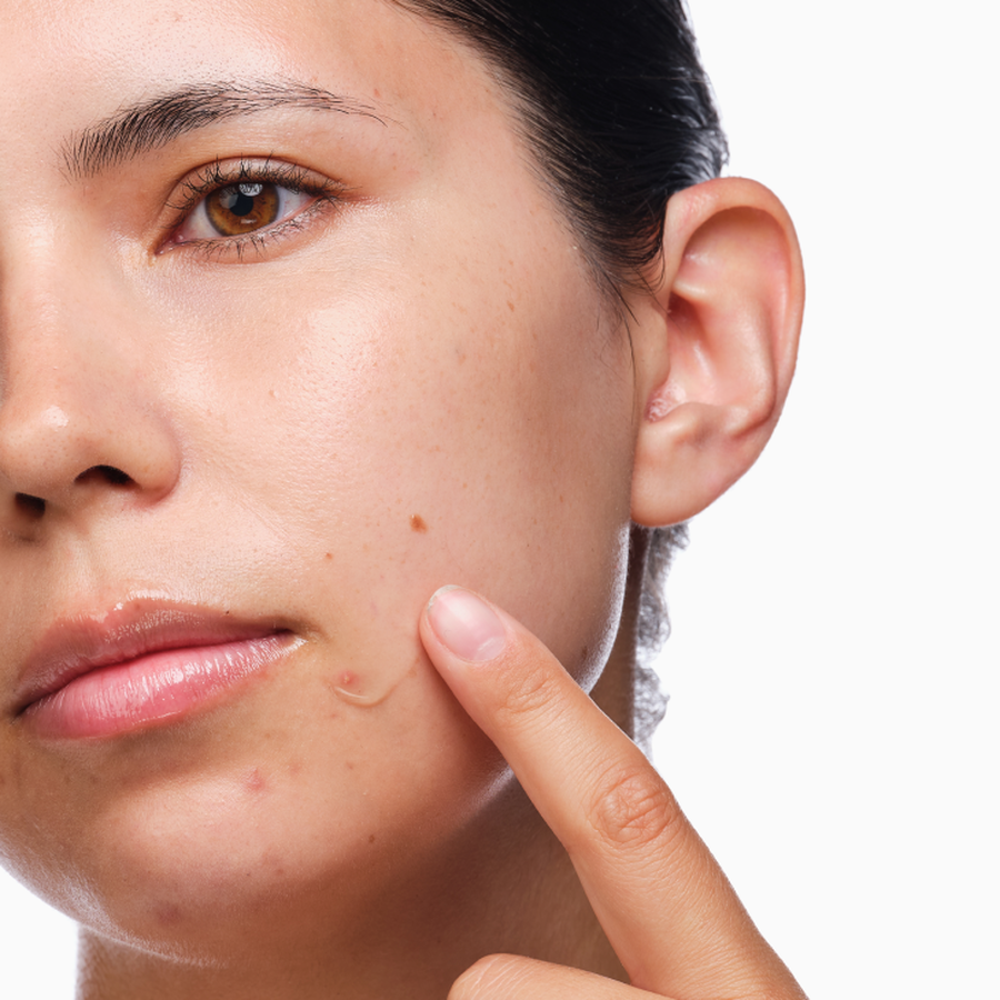 the-acne-set-w1 rdn-the-acne-set-application.png